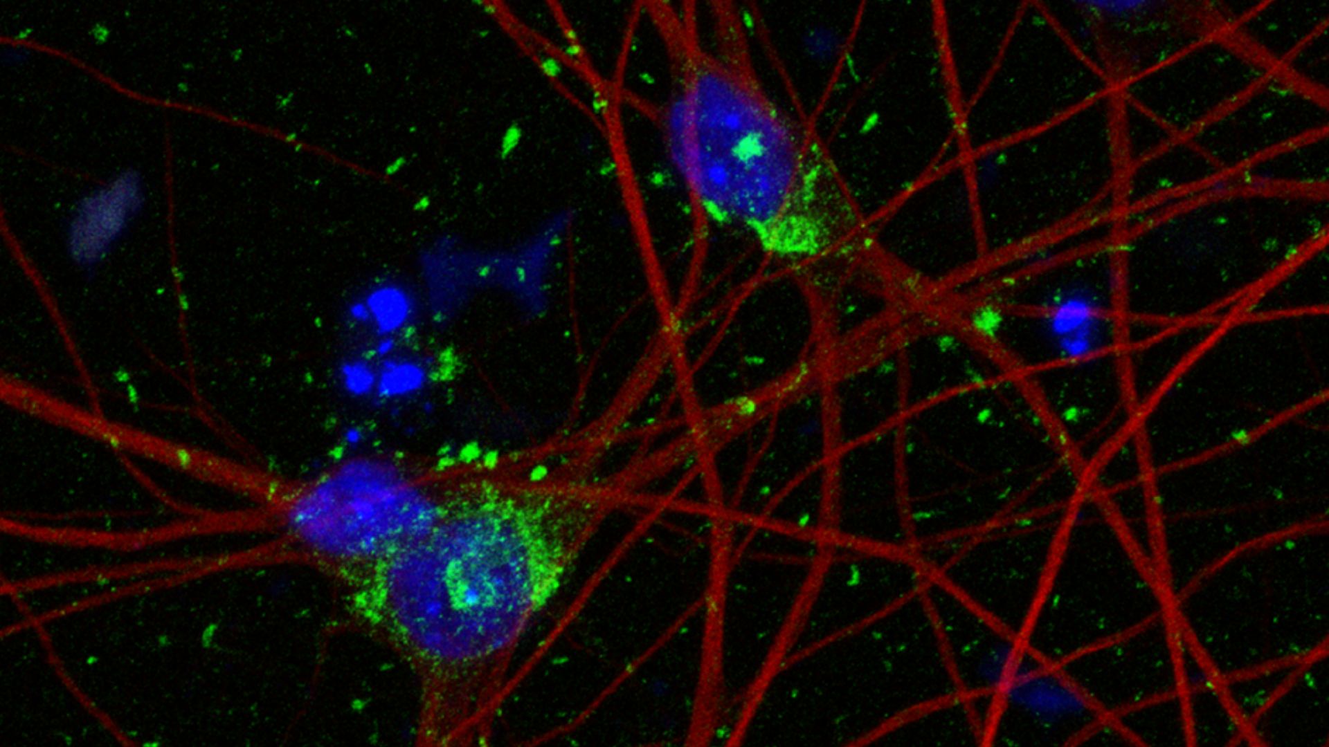 New human neuron model sparks hope for Alzheimer’s treatment [Video]