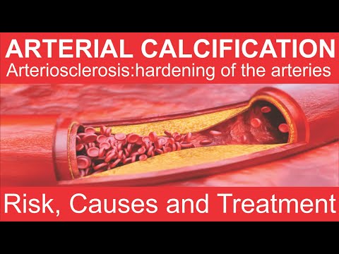 Arterial Calcification: Risks, Causes, and Treatments [Video]