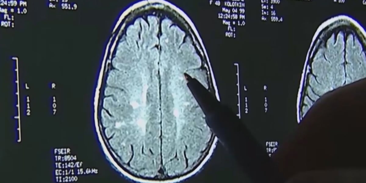 Alzheimers disease more prevalent in Black and Hispanic communities, study says [Video]