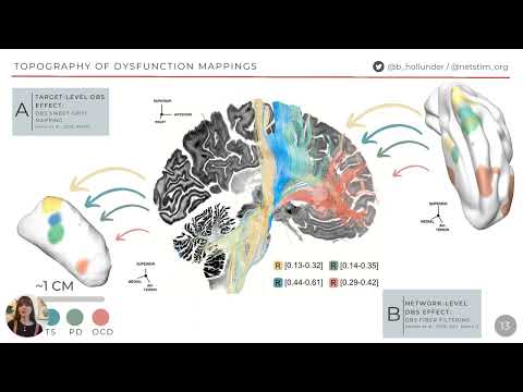 OHBM 2023 | 3024 | Talk | Barbara Hollunder | Mapping Dysfunctional Circuits in the Frontal Cortex… [Video]