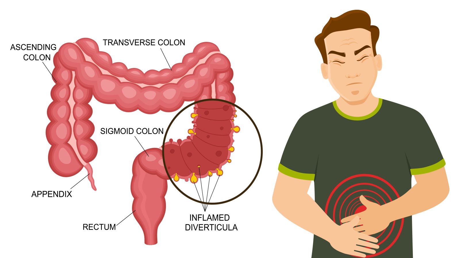 10 Signs of Diverticulitis (and What To Do) [Video]