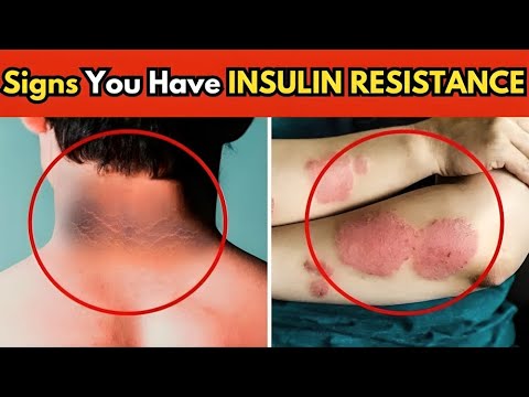 6  Signs You Have INSULIN RESISTANCE in 2024 [Video]