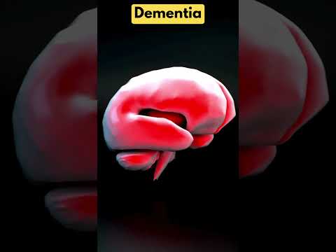 How to Prevent Dementia with Deep Sleep [Video]