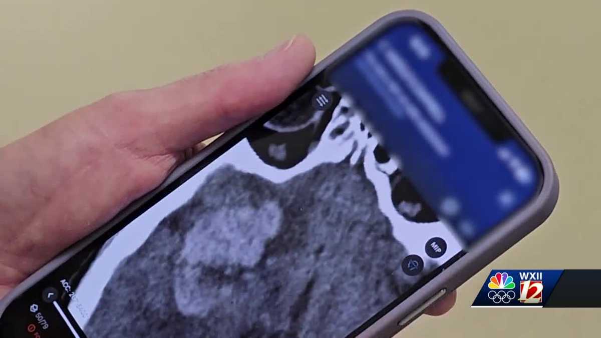 Local doctors utilize advancing technology to help treat stroke [Video]