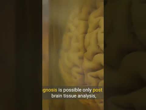 Treatment Of Alzheimer’s Disease [Video]