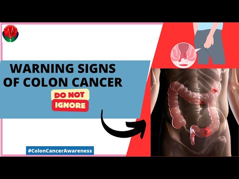Early detection of colon cancer | Don’t ignore. [Video]