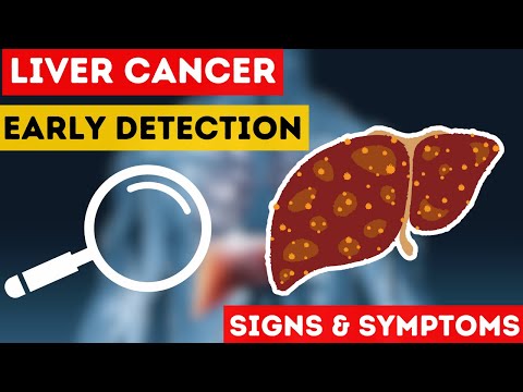 Liver Cancer: Uncovering Causes, Symptoms, & Early Detection [Video]