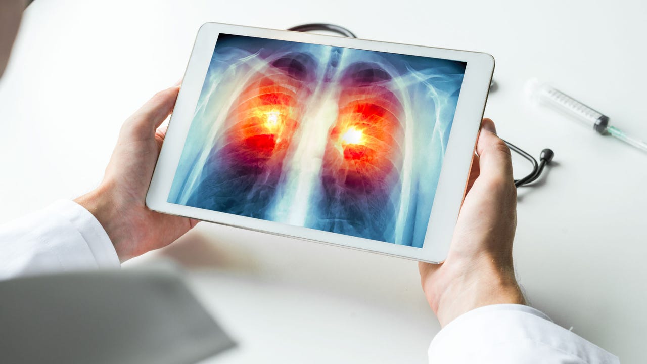Just 18% of Americans who need lung cancer screenings get one [Video]