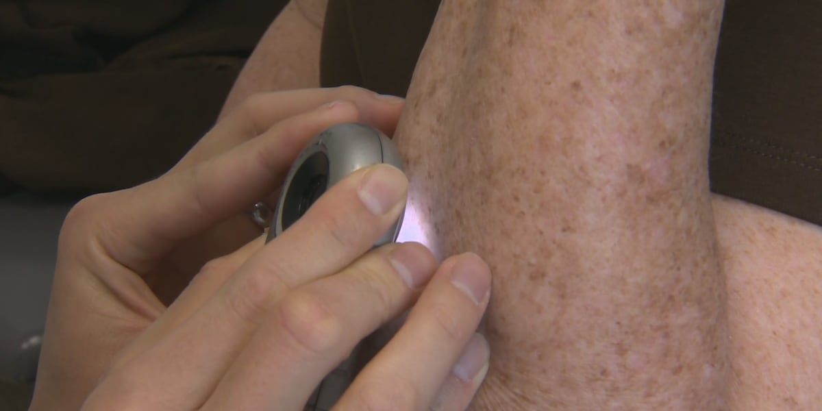 Free skin cancer event in Colorado Springs [Video]