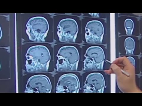 Alzheimer’s Disease expert breaks down new drug treatment [Video]