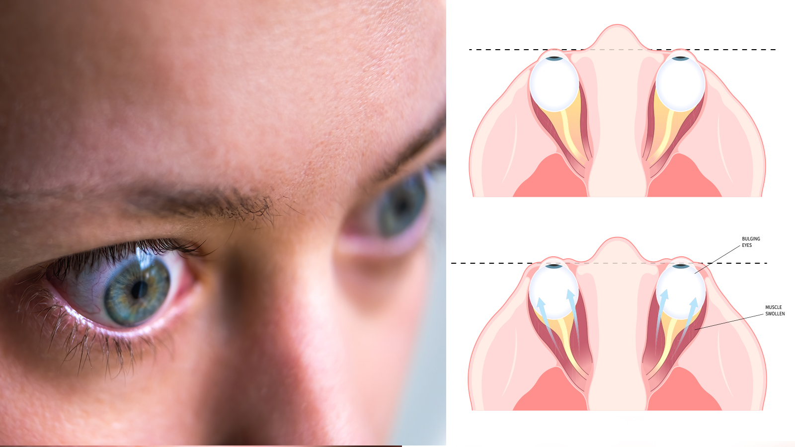10 Signs of Thyroid Eye Disease (and How to Help it) [Video]