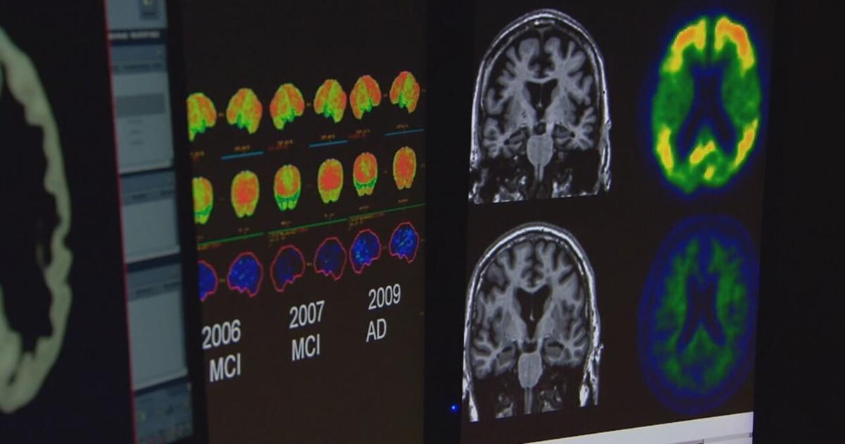 Doctors highlight Alzheimer’s and Brain Awareness Month with new treatments | Morning [Video]