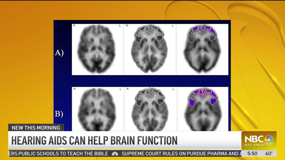 Study says hearing aids can slow down cognitive impairment  NBC Bay Area [Video]