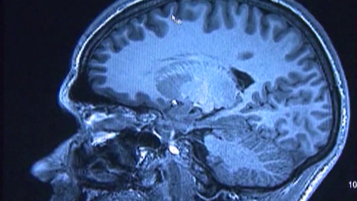 Alzheimer’s treatments, drugs showing some promise, health experts say [Video]