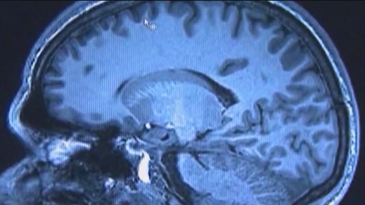 Alzheimer’s treatments providing some hope [Video]