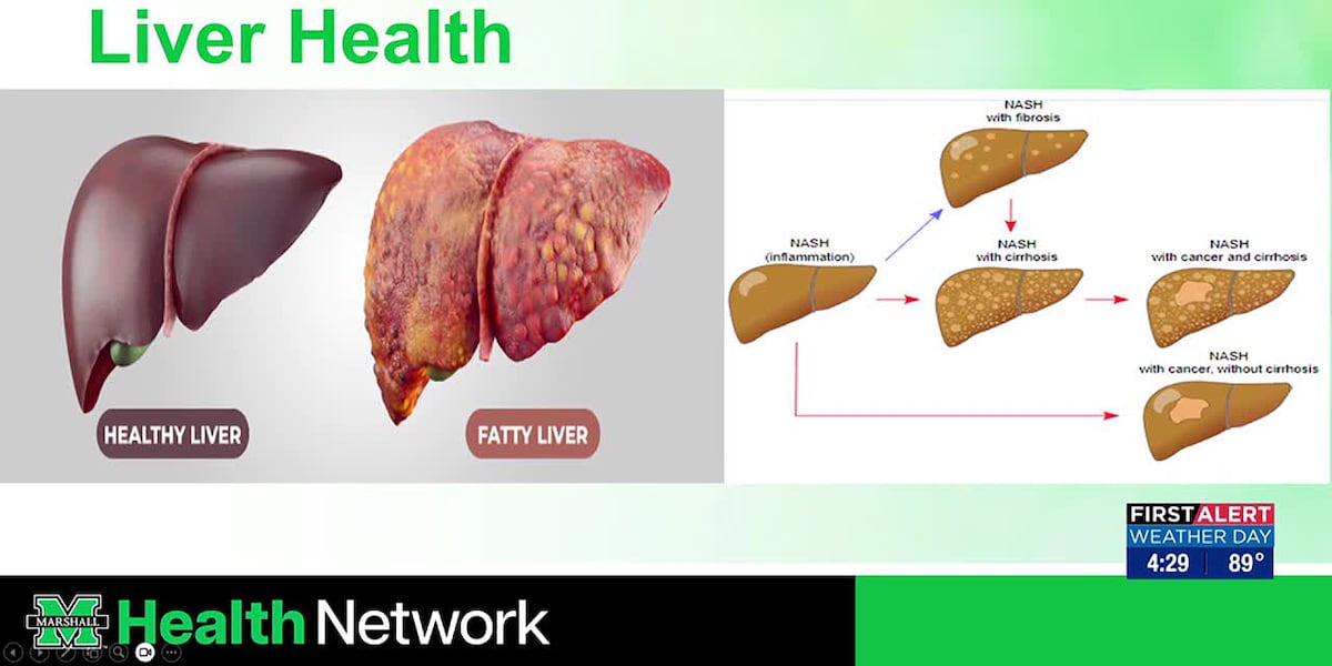 Treating Fatty Liver Disease with Marshall Health Network [Video]
