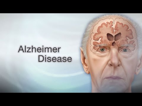 Alzheimer’s Explained: The Reality Behind Memory Loss and Confusion [Video]
